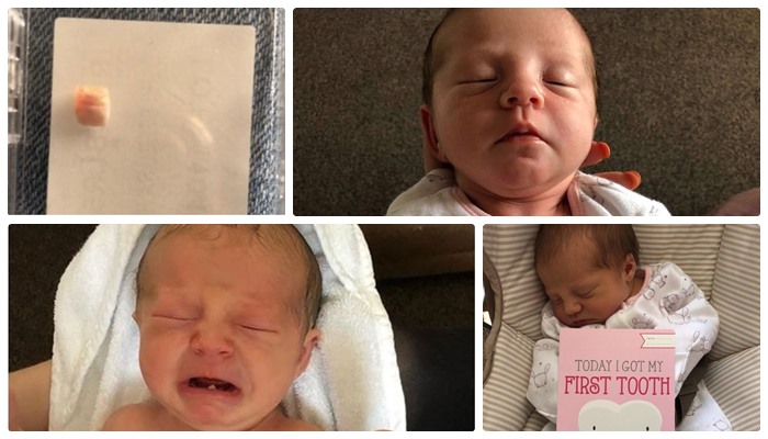 Dünyada ilk: Henüz 12 günlük bebeğin dişi çekildi