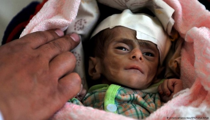 Yemen’de açlık tehdidi altındaki çocuk sayısı 5.2 milyona ulaştı