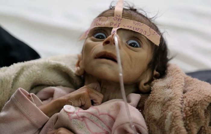2021’de beş yaş altı en az 400 bin Yemenli çocuk açlıktan ölebilir