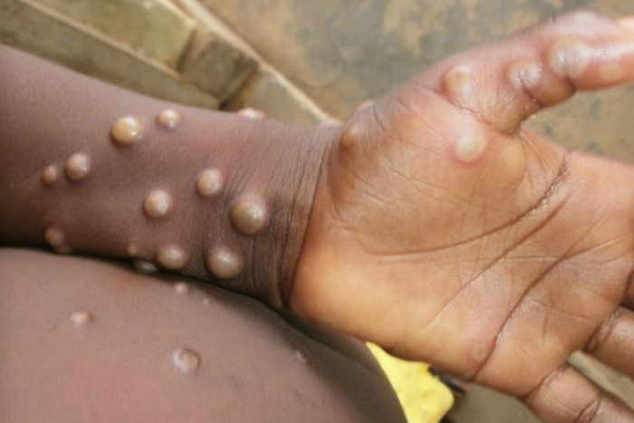 AB sağlık ajansı: Avrupa daha fazla mpox vakasına hazırlıklı olmalı
