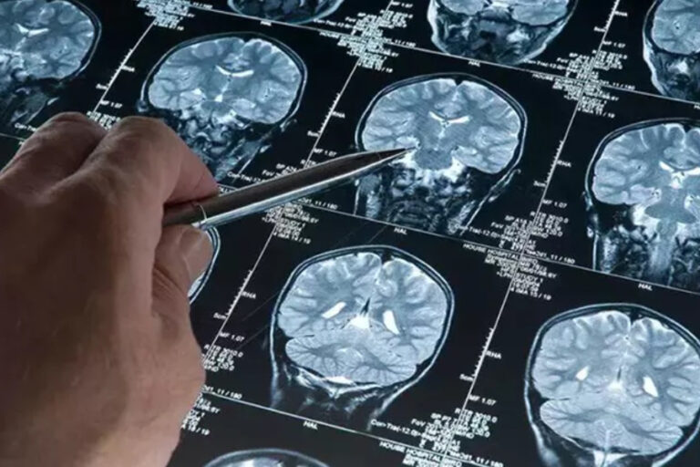 Alzheimer hastalığını erken evrede tespit edebilen kan testi geliştirildi